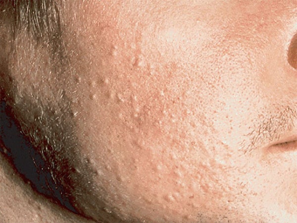 Mụn ẩn có kích thước nhỏ