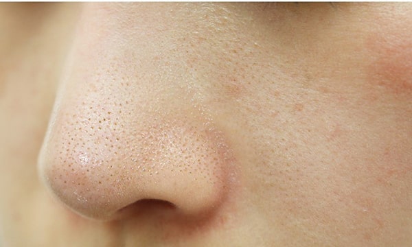 Các loại mụn thường gặp ở nam giới