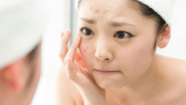 Sữa rửa mặt hạn chế nguy cơ nổi mụn