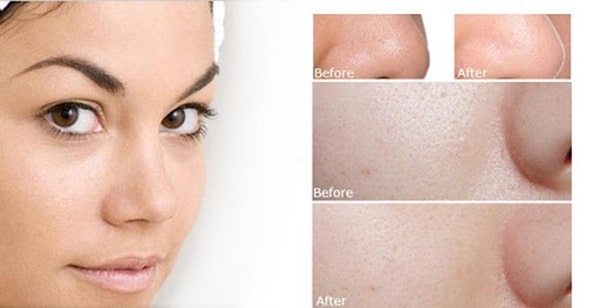 Sữa rửa mặt giúp thu gọn lỗ chân lông