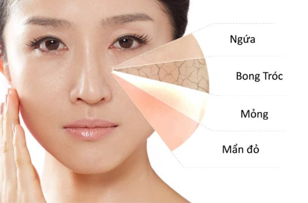 Da nhạy cảm dễ bị kích ứng, mẩn đỏ