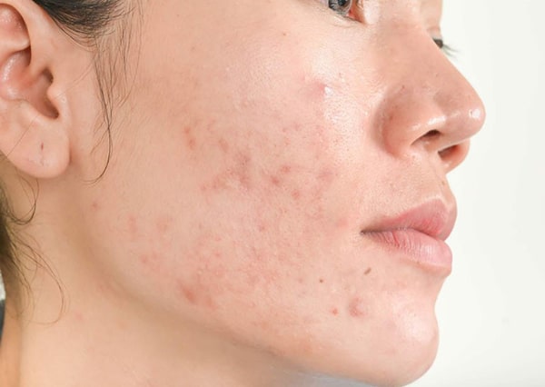 Thâm mụn khiến làn da kém sắc