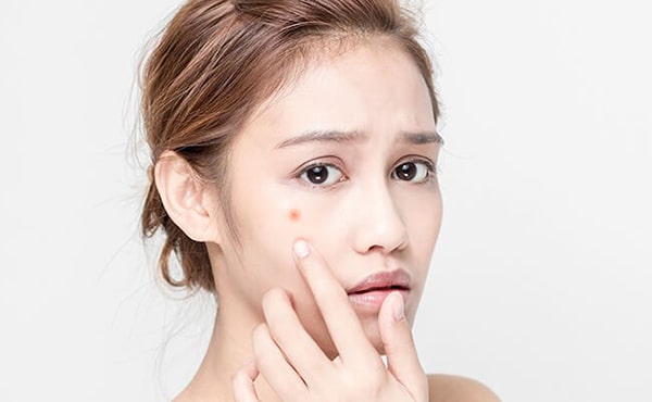 Hiểu rõ làn da trước khi chọn mua kem trị mụn